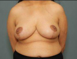 BREAST REDUCTION: Case 49 After